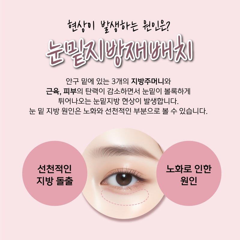 부산눈밑지방재배치, 자연스러운 인상개선으로 달라질 수 있어요