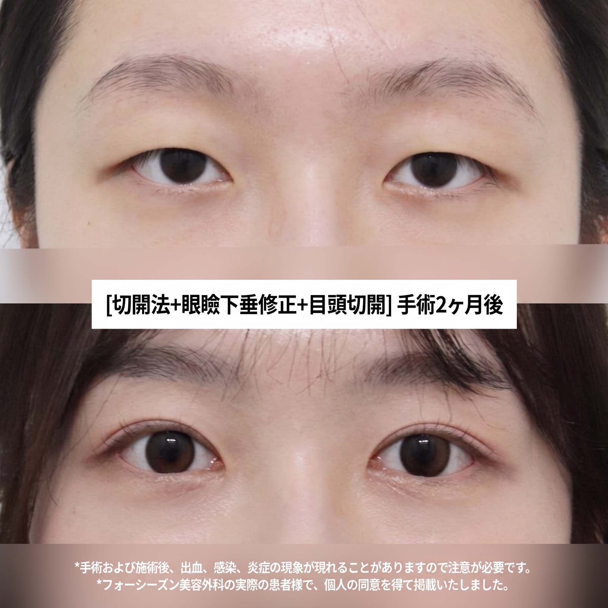 ソミョン二重手術が上手な病院 二重まぶた手術と上眼瞼手術、どんな違いがある？ 사진 2