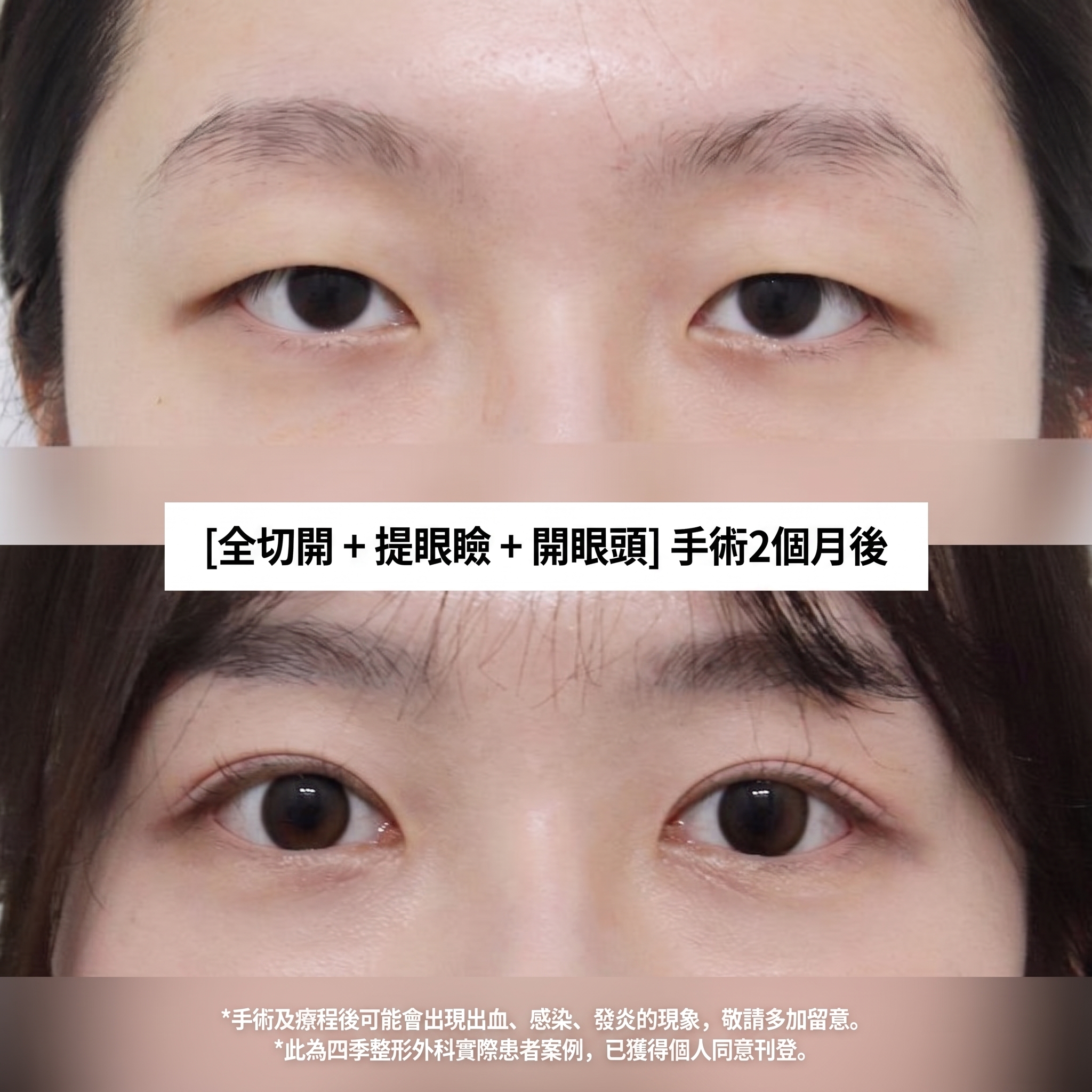 西面雙眼皮手術做得好的地方 雙眼皮手術與上眼瞼手術有何不同？ 사진 2