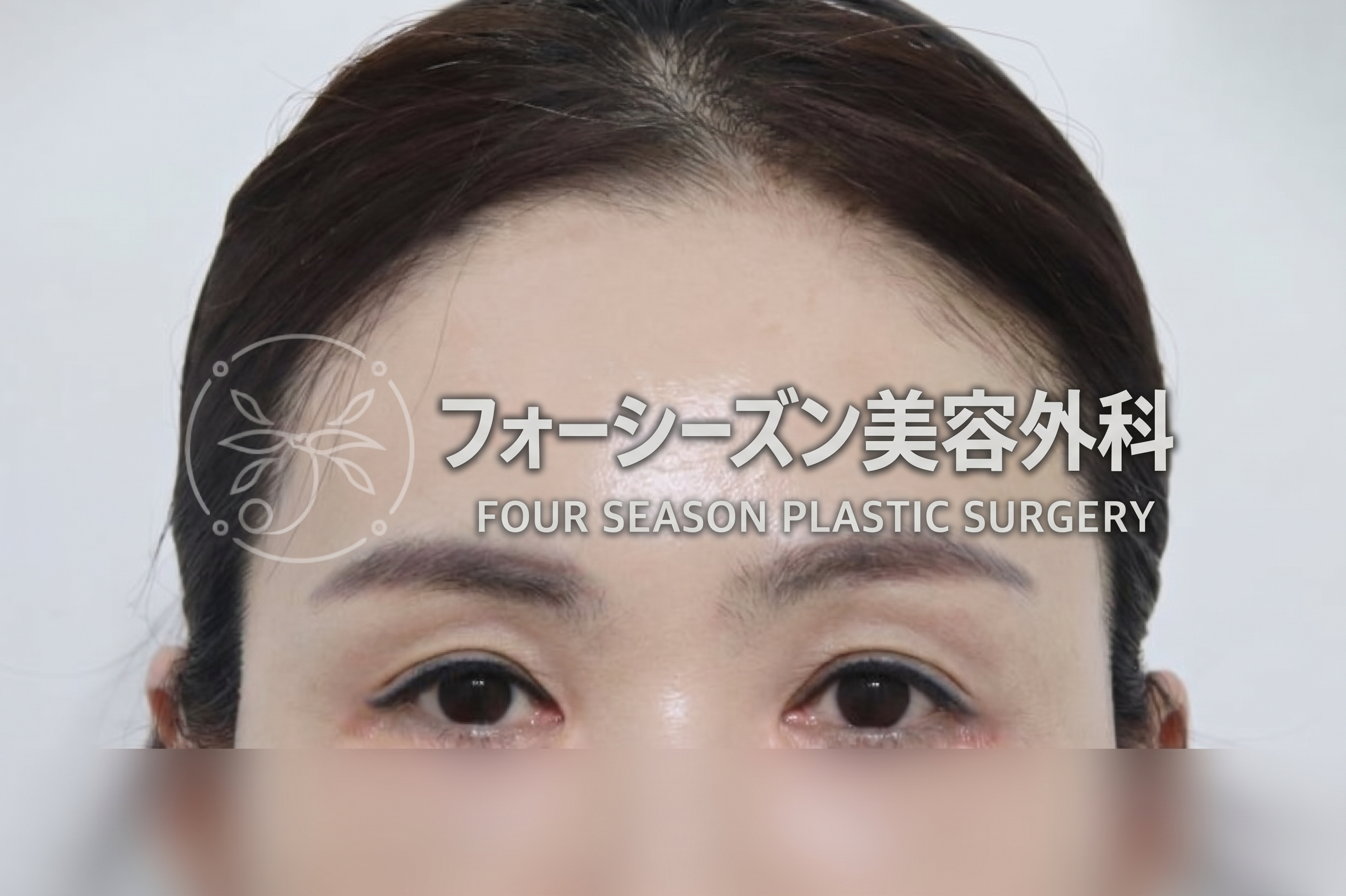 釜山額リフト、二重まぶた手術だけでは不十分な場合 사진 2