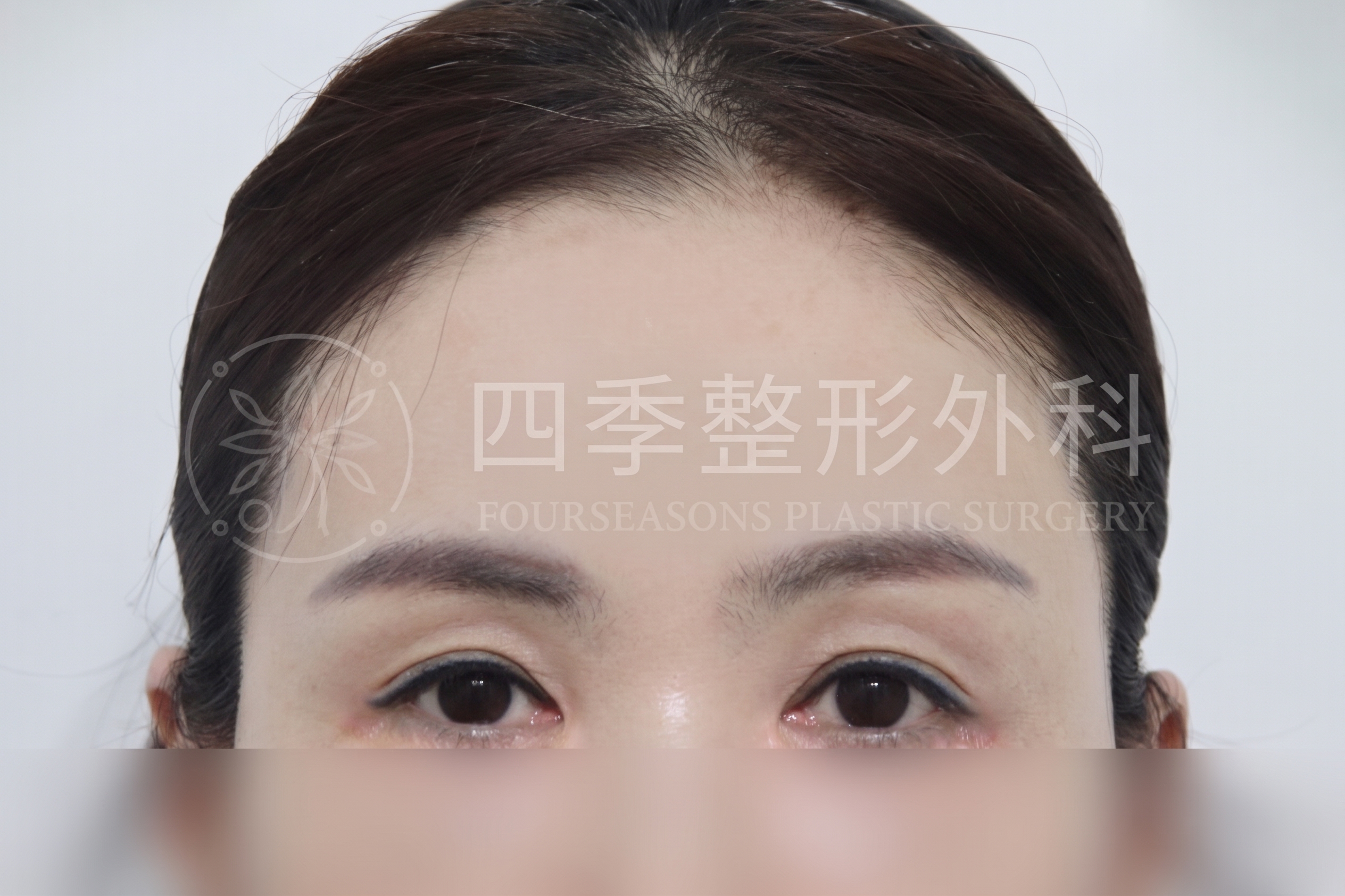 釜山額頭拉提：如果只做雙眼皮手術還不夠 사진 2