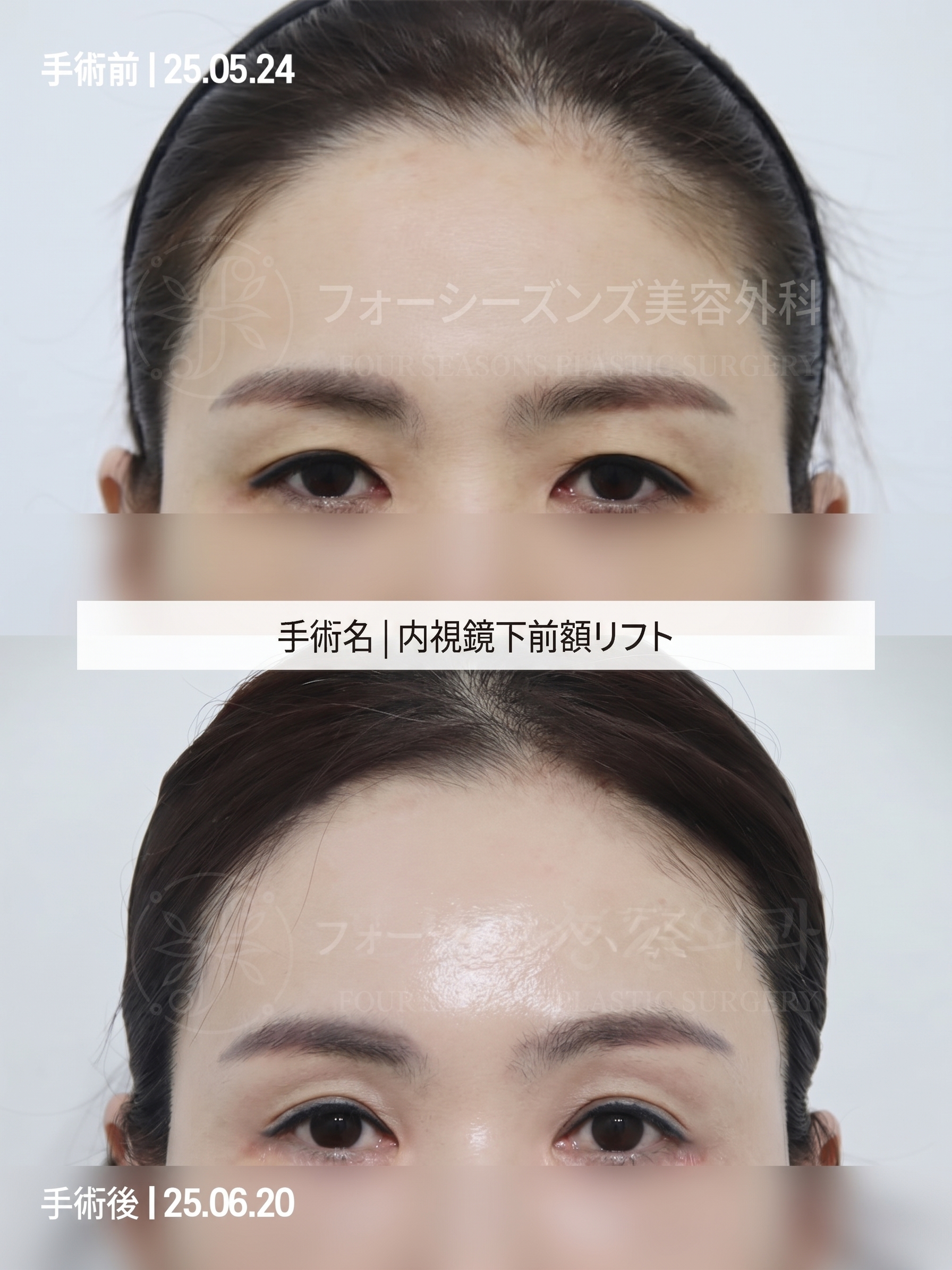 釜山額リフト、二重まぶた手術だけでは不十分な場合 사진 4