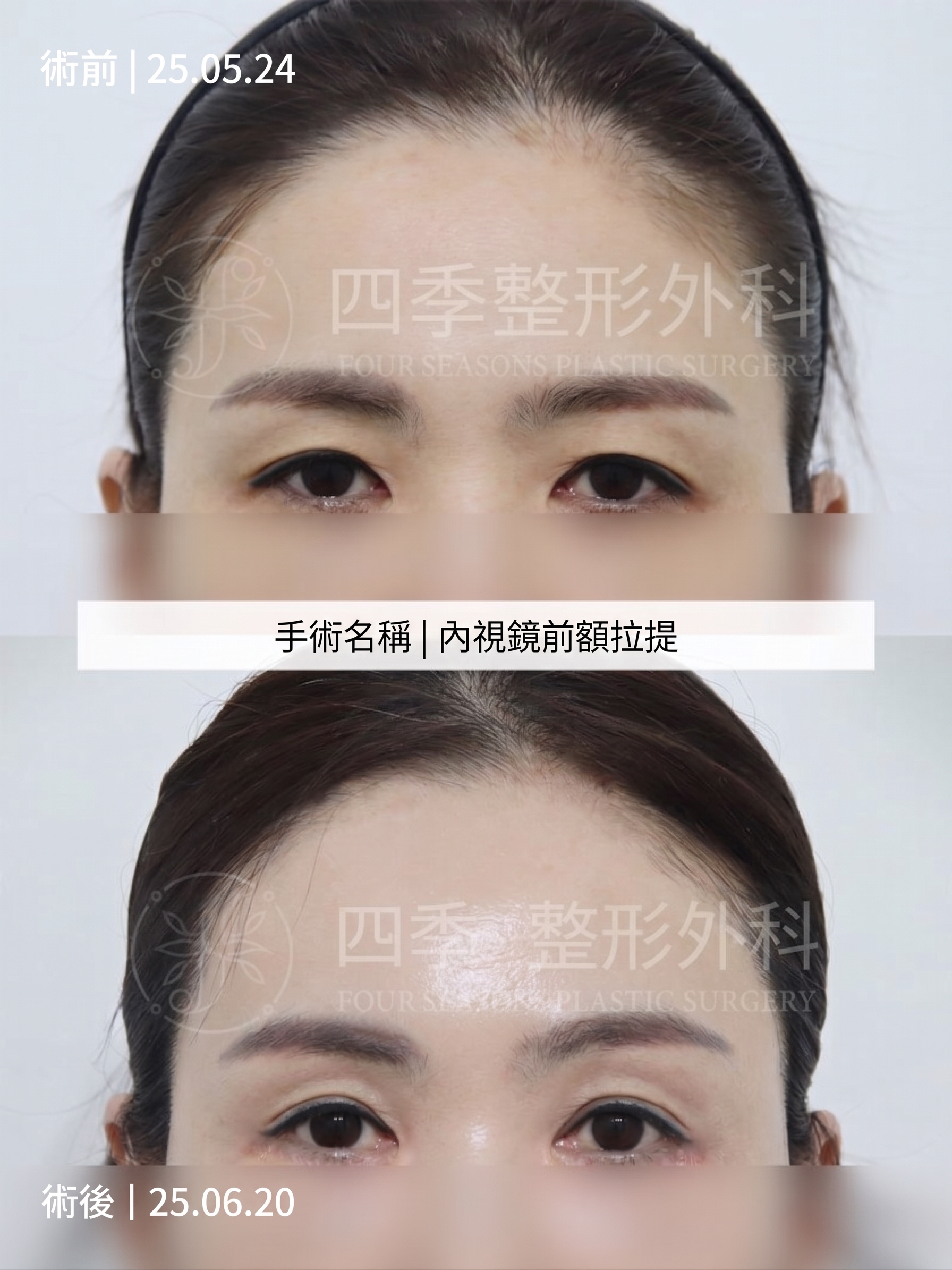 釜山額頭拉提：如果只做雙眼皮手術還不夠 사진 4