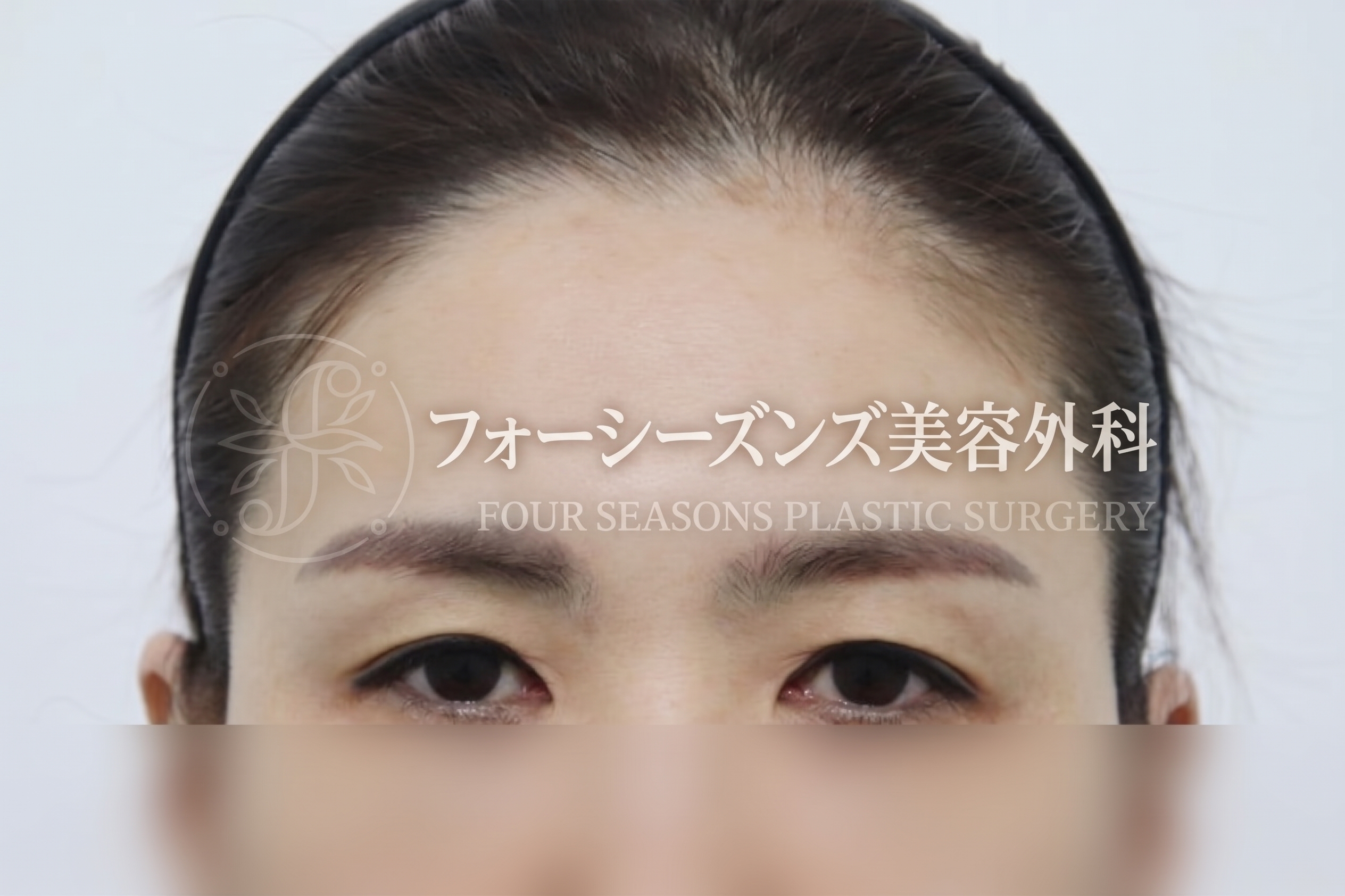 釜山額リフト、二重まぶた手術だけでは不十分な場合
