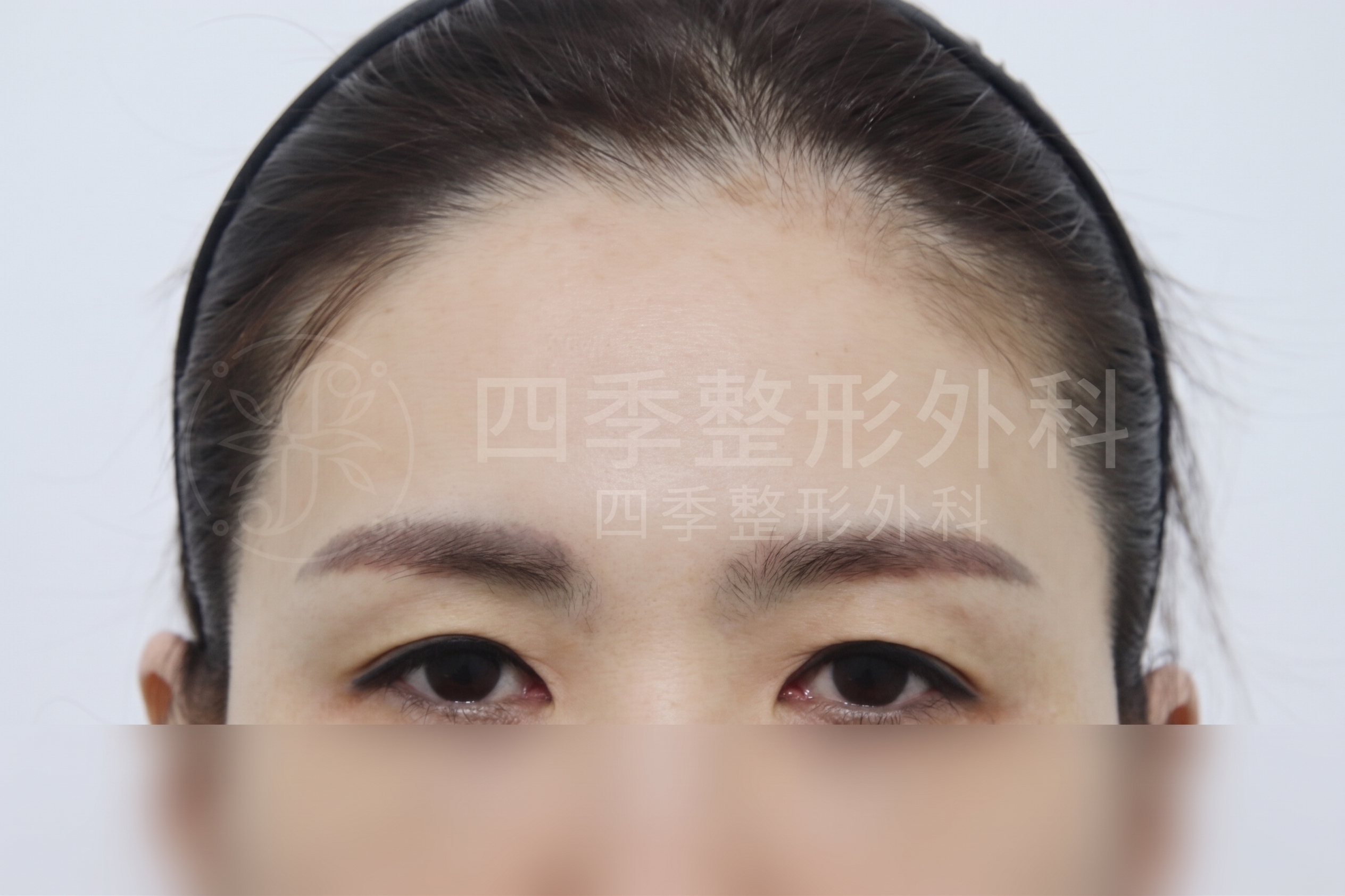 釜山額頭拉提：如果只做雙眼皮手術還不夠
