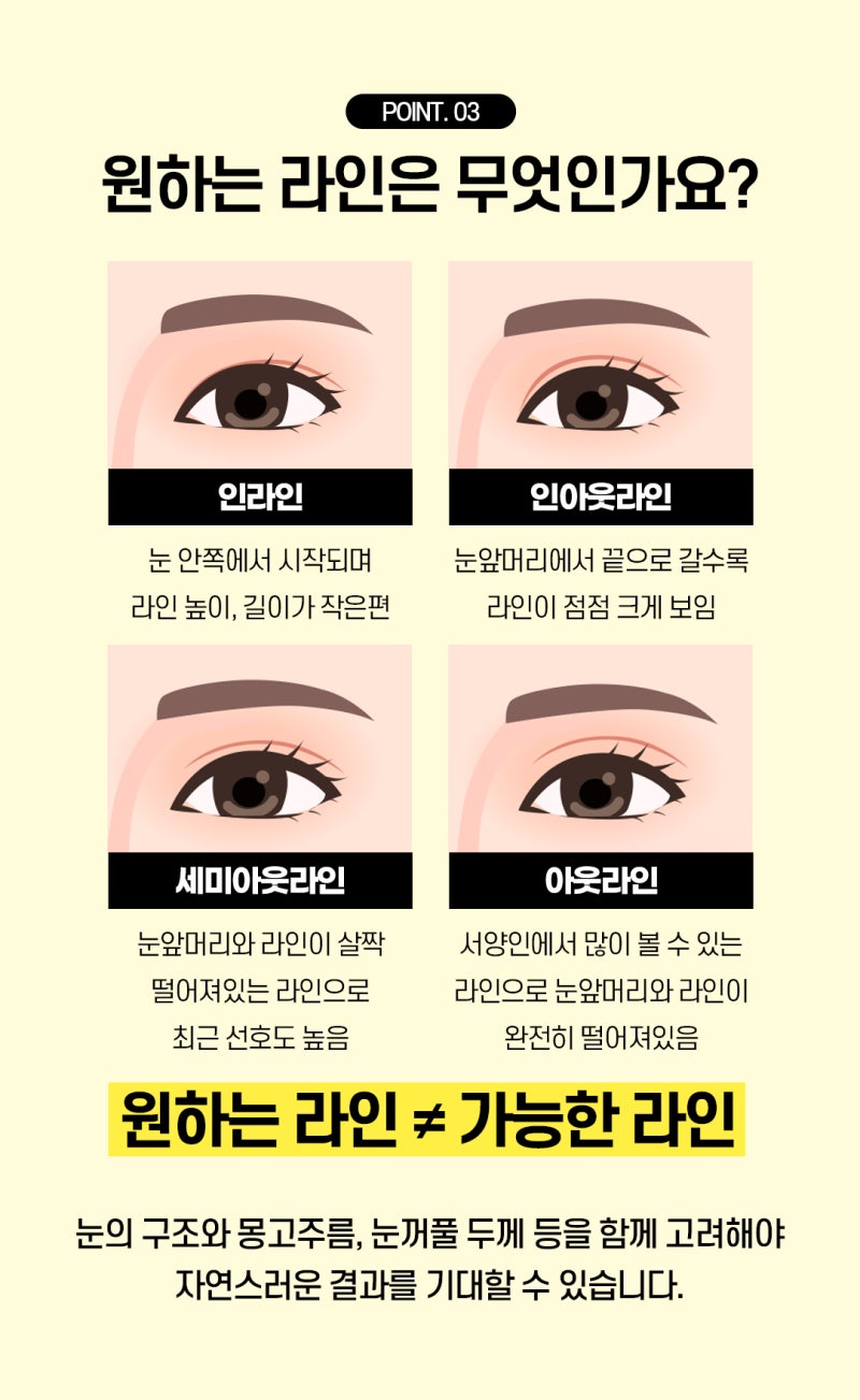 부산눈성형, 내 눈에 맞는 수술법 찾는 방법 사진 6
