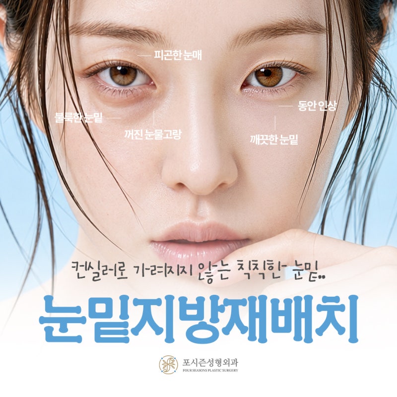 눈밑지방재배치, 다크서클과 불룩한 눈밑 한번에 개선 사진 2