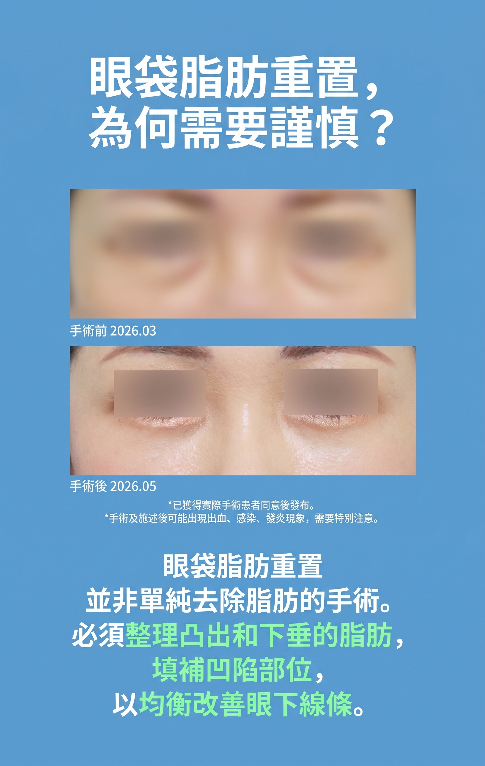 眼底脂肪重新排列，一次改善黑眼圈和眼底浮腫 사진 3