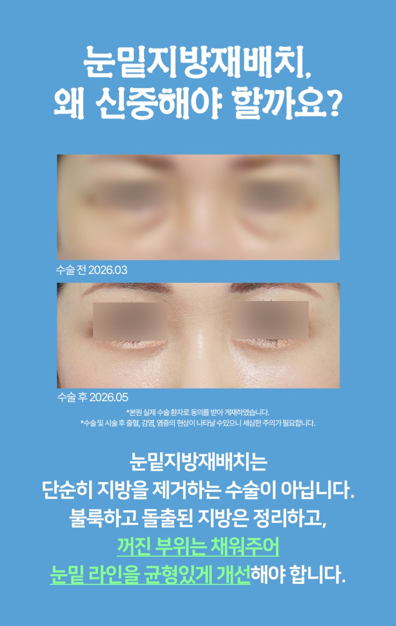 눈밑지방재배치, 다크서클과 불룩한 눈밑 한번에 개선 사진 3