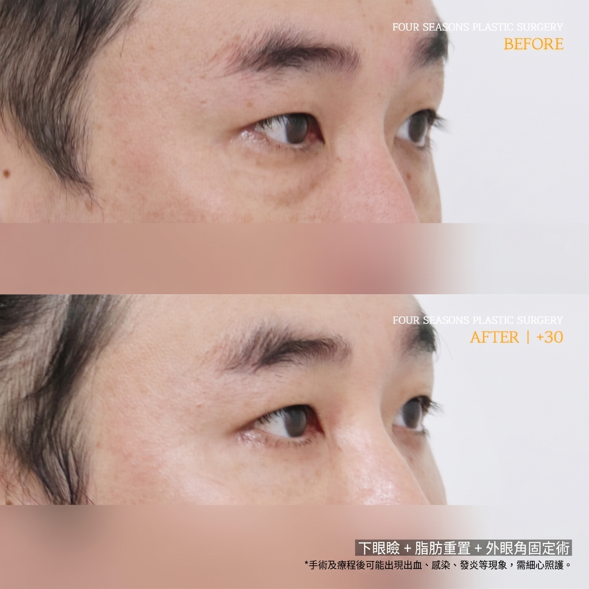 西面下眼瞼手術 費用差異的原因何在？ 사진 6