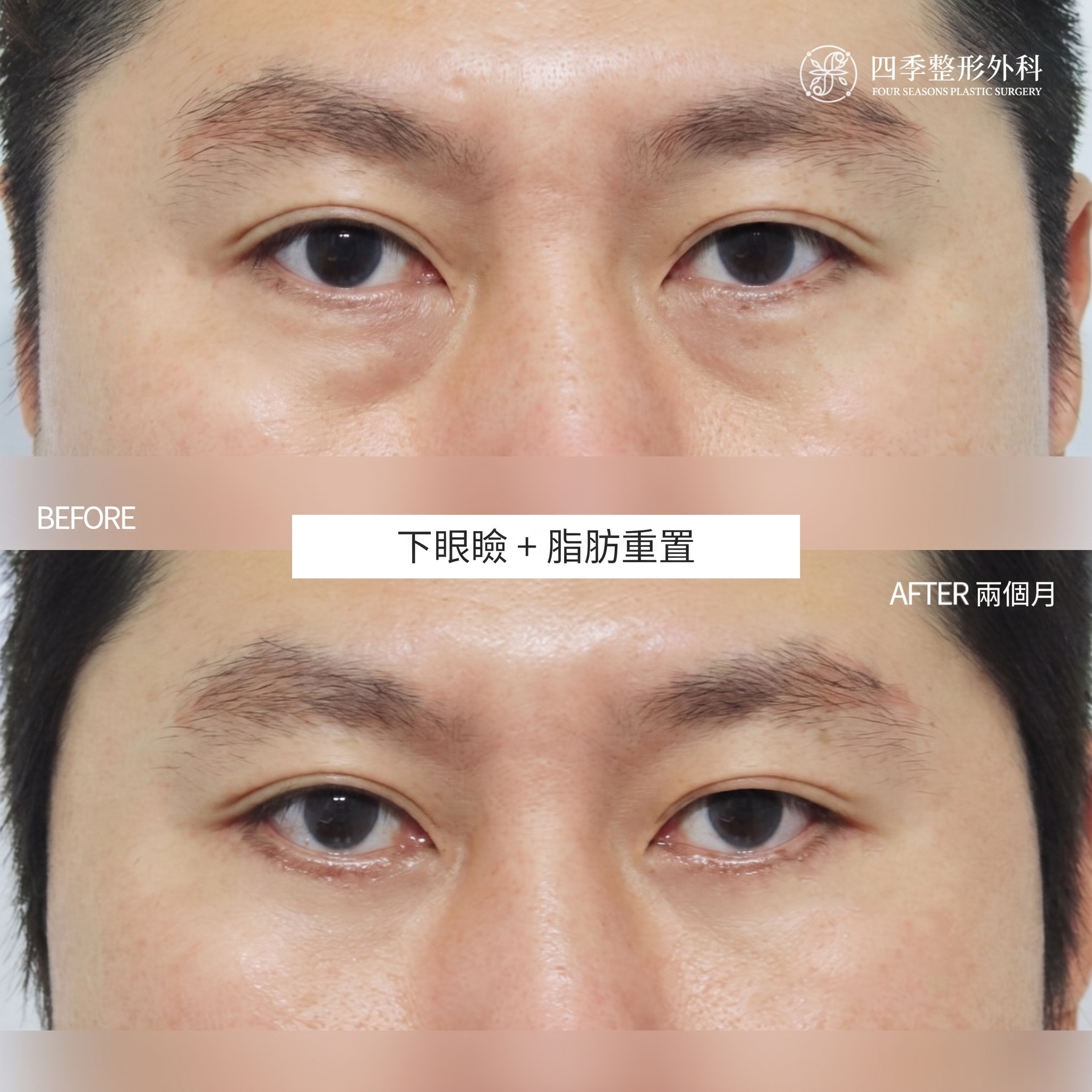 西面下眼瞼手術 費用差異的原因何在？ 사진 2
