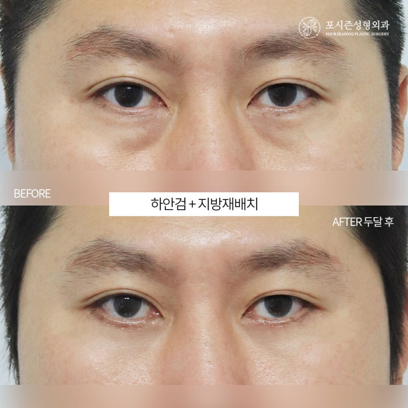 서면하안검수술 수술 비용이 달라지는 이유