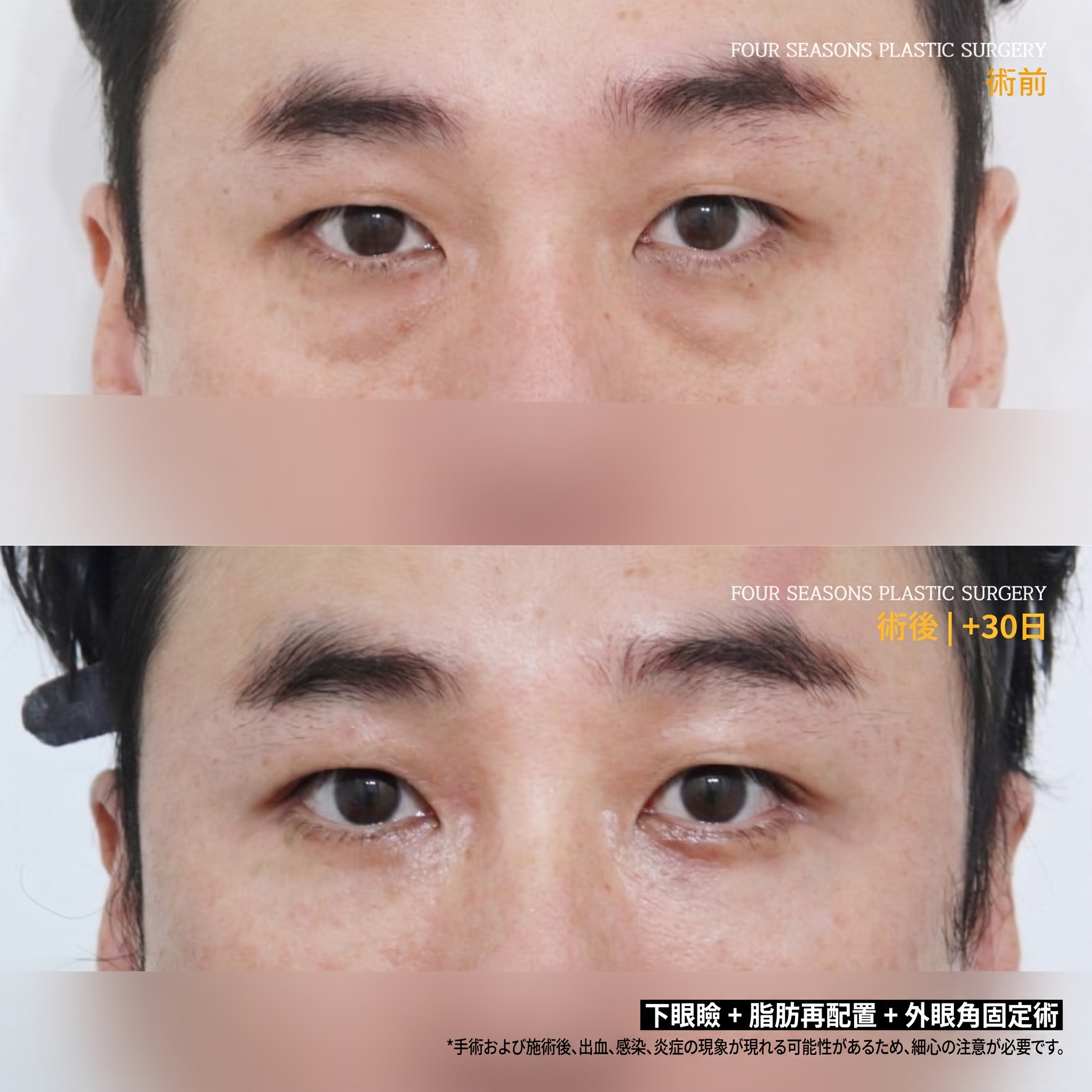 西面下眼瞼手術 費用が異なる理由とは？ 사진 4