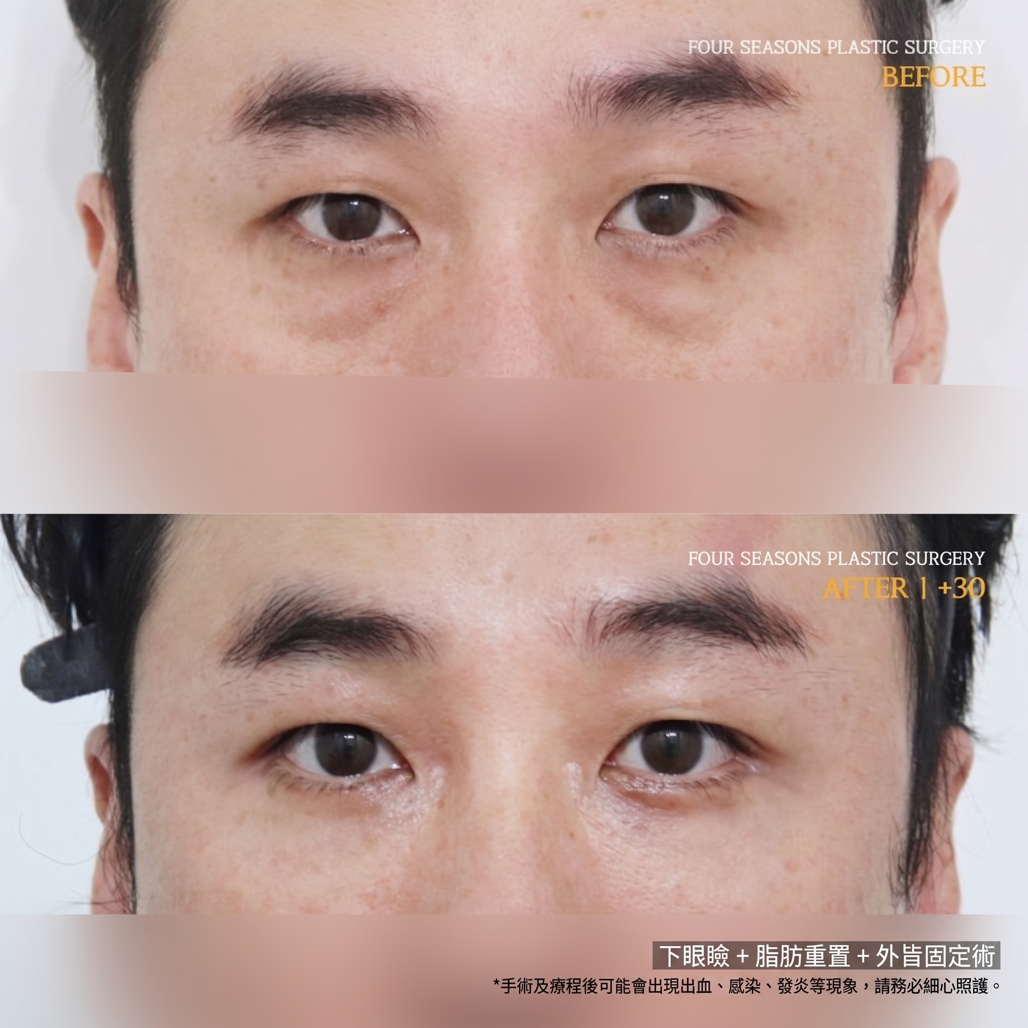 西面下眼瞼手術 費用差異的原因何在？ 사진 4