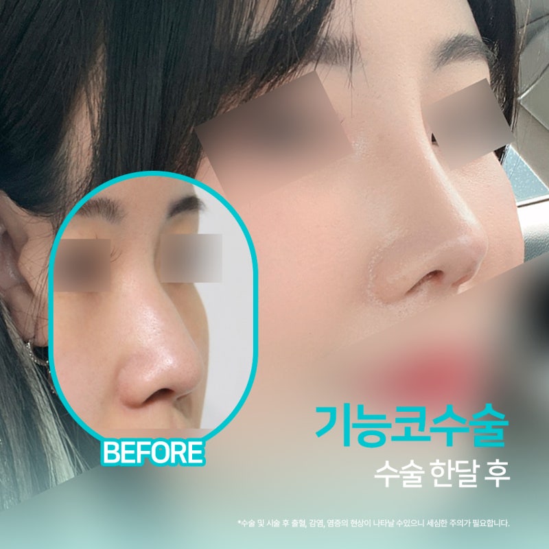 부산기능코 구조적 비염과 외형 개선을 동시에 사진 5