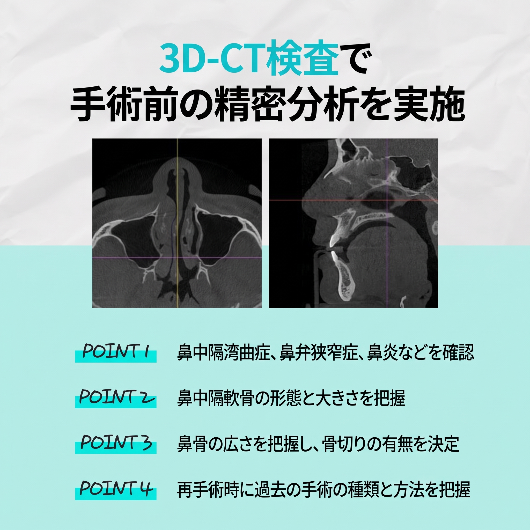 釜山機能性鼻整形：構造的鼻炎と外見の改善を同時に 사진 4