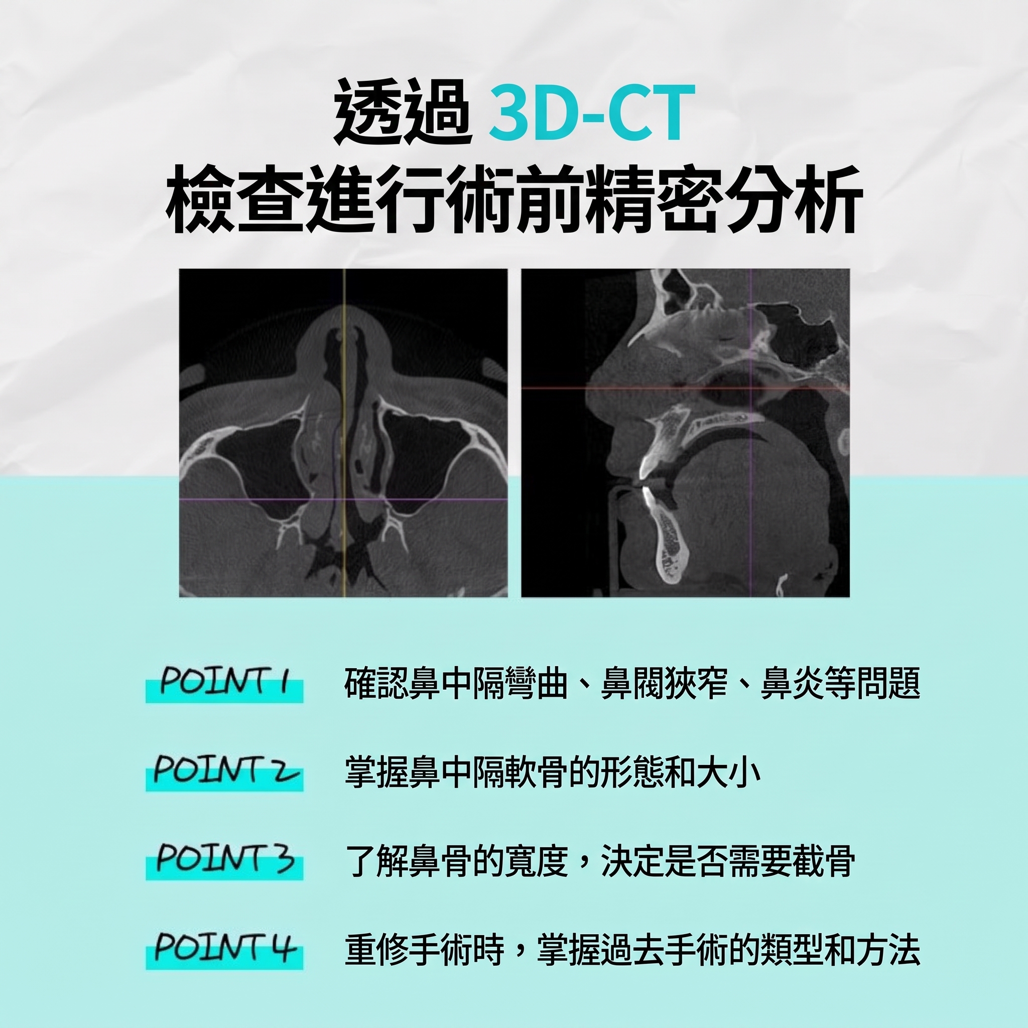 釜山功能性鼻整形：同時改善結構性鼻炎與外觀問題 사진 4