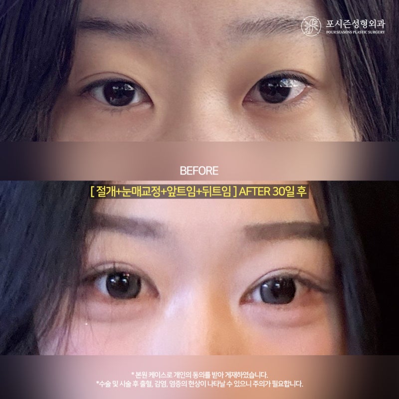 서면쌍수재수술 내게 어울리는 눈을 다시 설계하는 과정은 사진 3