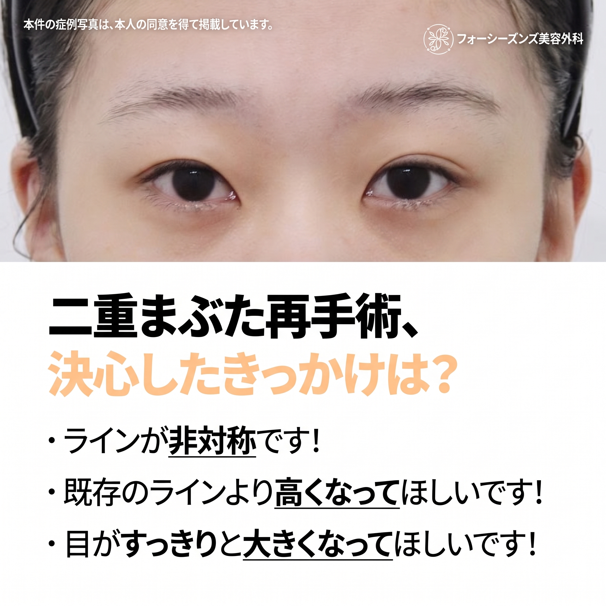 西面（ソミョン）二重再手術 自分に似合う目元を再設計するプロセスとは 사진 2