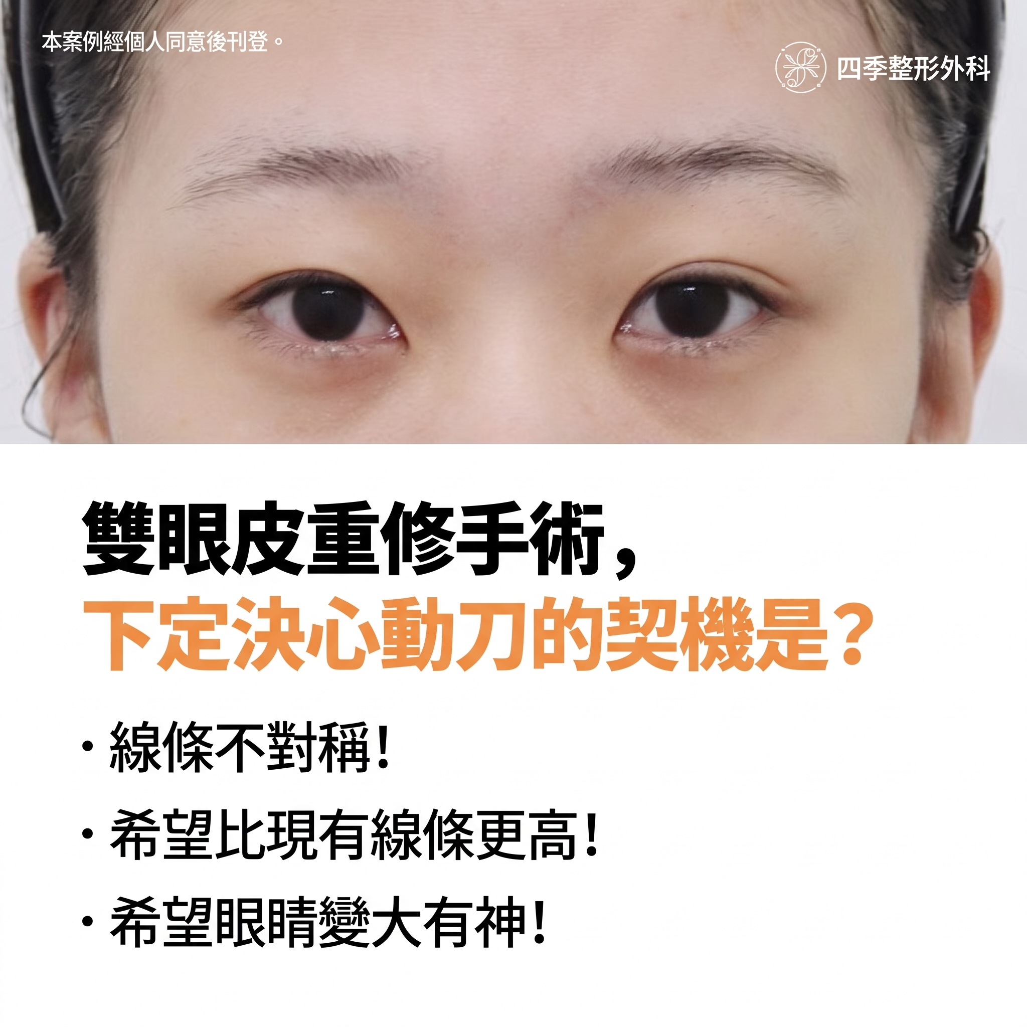 西面雙眼皮修復手術：重新為我量身打造專屬眼型的全過程 사진 2