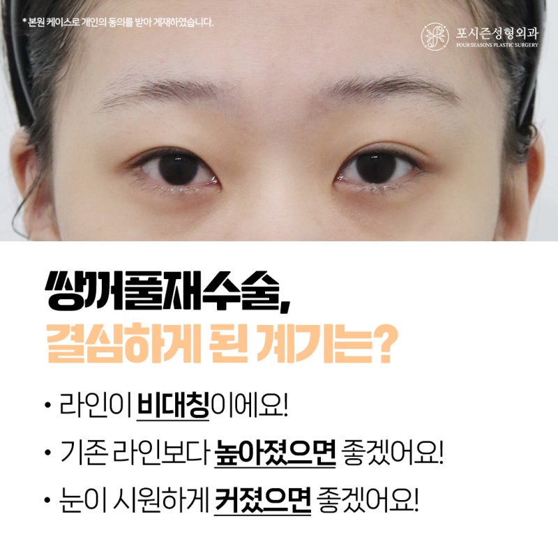 서면쌍수재수술 내게 어울리는 눈을 다시 설계하는 과정은