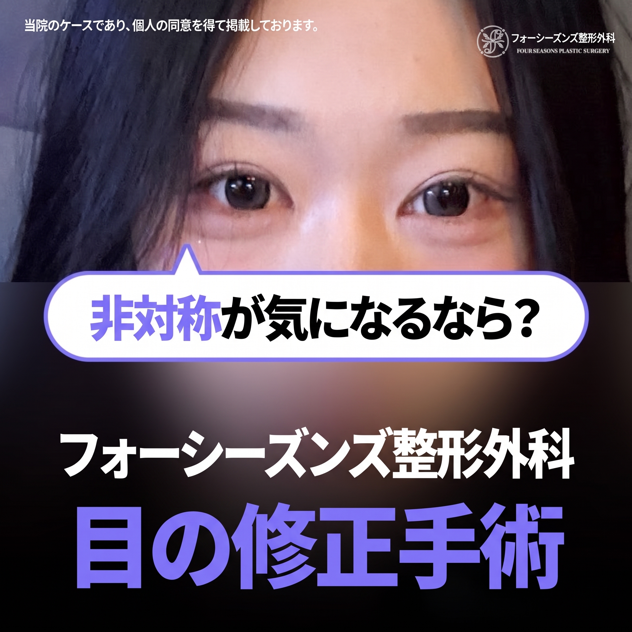 西面（ソミョン）二重再手術 自分に似合う目元を再設計するプロセスとは