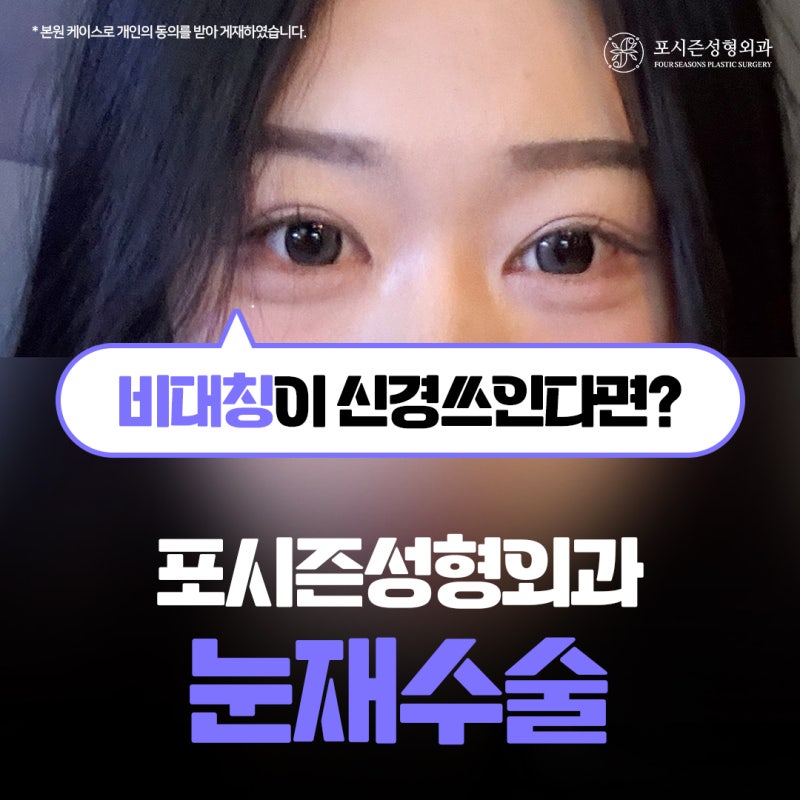 서면쌍수재수술 내게 어울리는 눈을 다시 설계하는 과정은