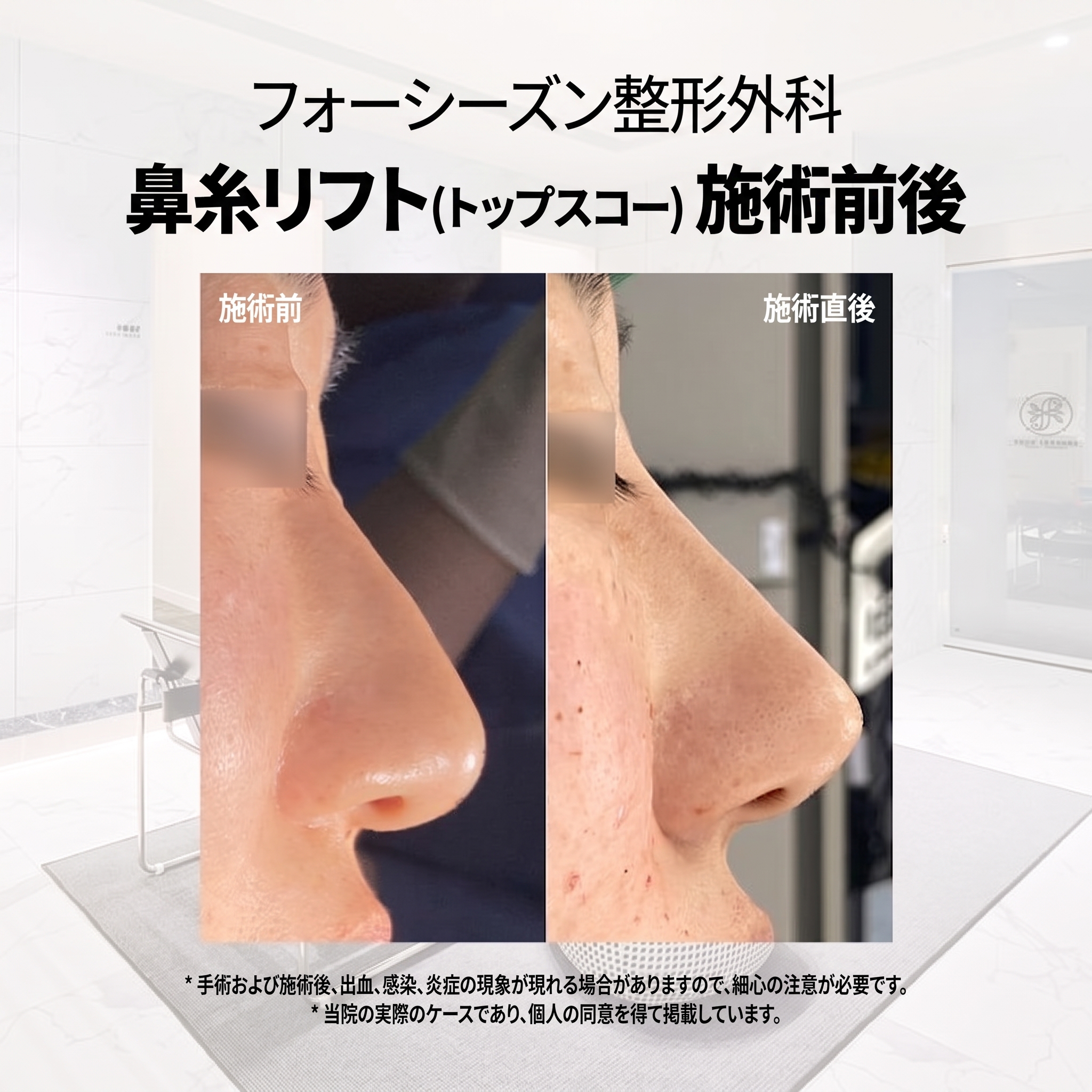 釜山鼻スレッドリフト:切開なしで鼻筋や小鼻を改善できる? 사진 5