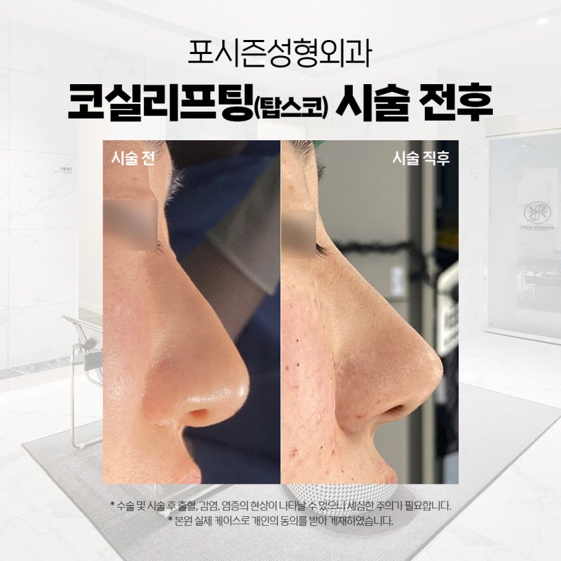 부산코실리프팅 비절개로 콧대,콧볼을 개선시킬 수 없을까? 사진 5