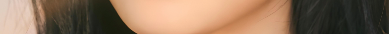 부산코실리프팅 비절개로 콧대,콧볼을 개선시킬 수 없을까? 사진 18