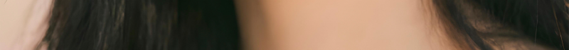부산코실리프팅 비절개로 콧대,콧볼을 개선시킬 수 없을까? 사진 23
