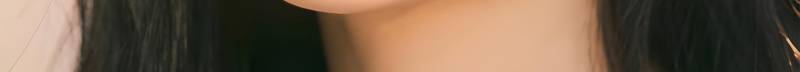 부산코실리프팅 비절개로 콧대,콧볼을 개선시킬 수 없을까? 사진 19