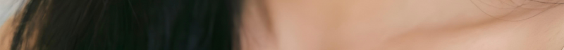부산코실리프팅 비절개로 콧대,콧볼을 개선시킬 수 없을까? 사진 21