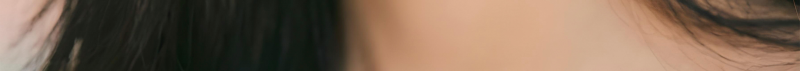 부산코실리프팅 비절개로 콧대,콧볼을 개선시킬 수 없을까? 사진 22