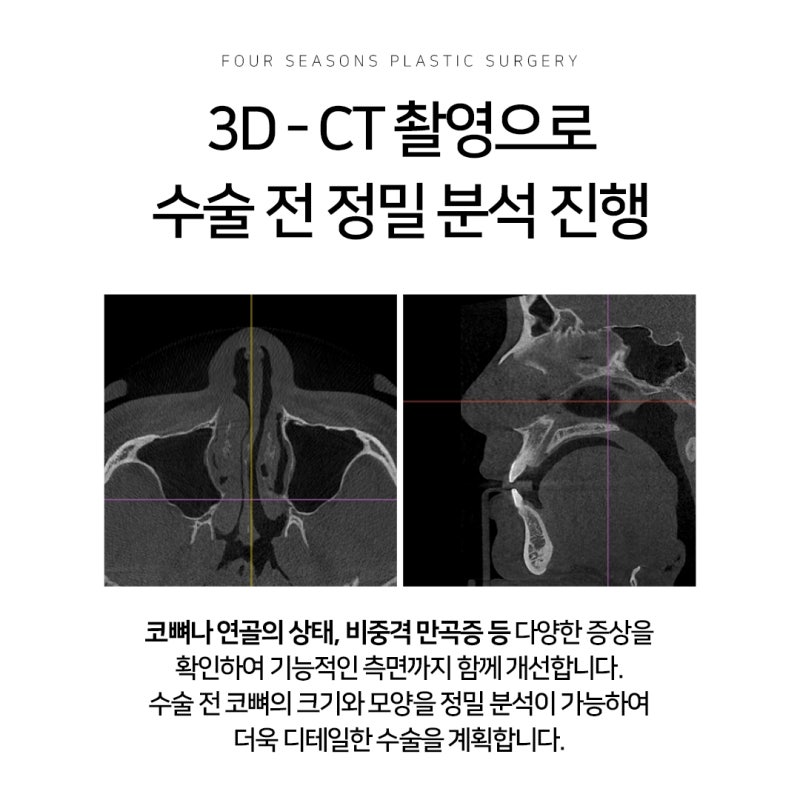 부산남자코성형 콧대보다 중요한 것은 얼굴과의 조화 사진 4