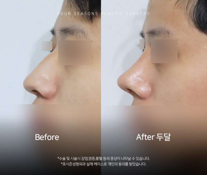 부산남자코성형 콧대보다 중요한 것은 얼굴과의 조화 사진 5