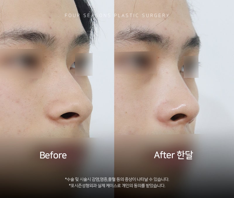 부산남자코성형 콧대보다 중요한 것은 얼굴과의 조화