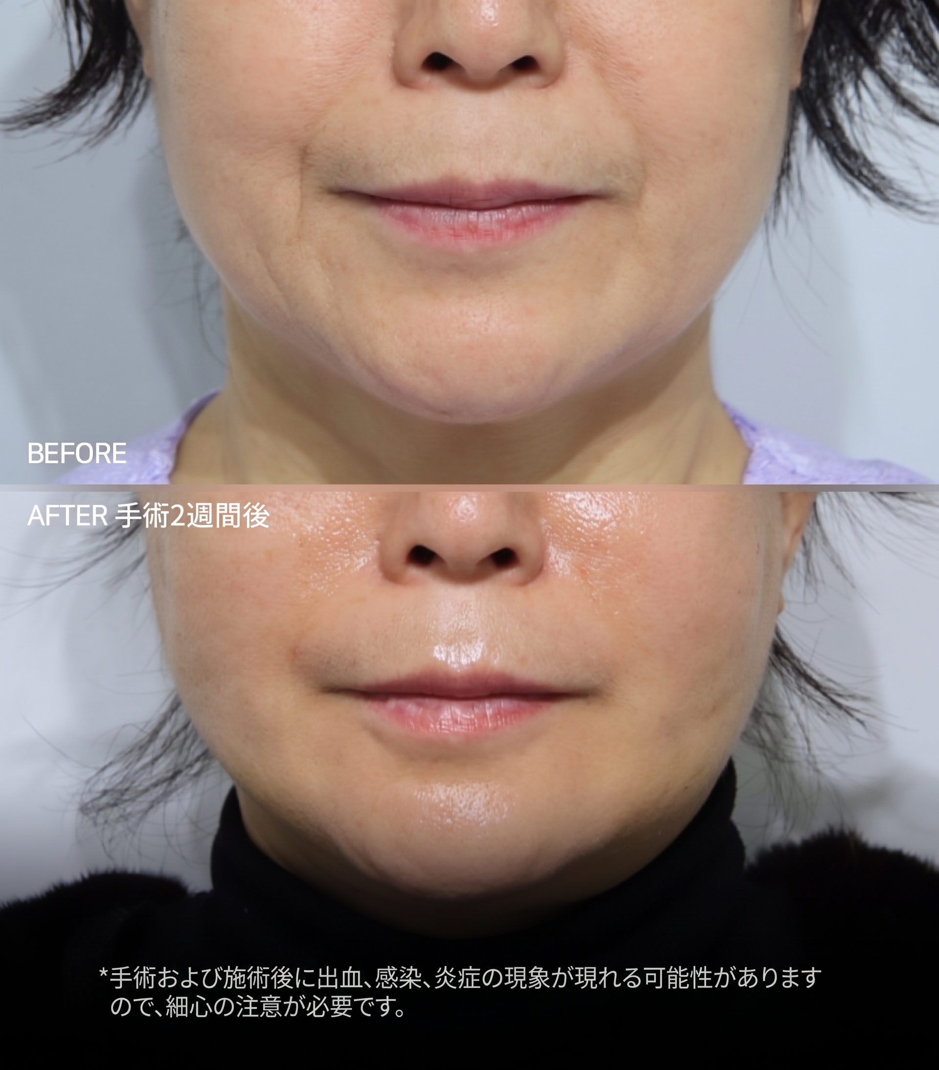 釜山ミニリフト、単に皮膚だけを引き上げてはいけない理由 사진 5