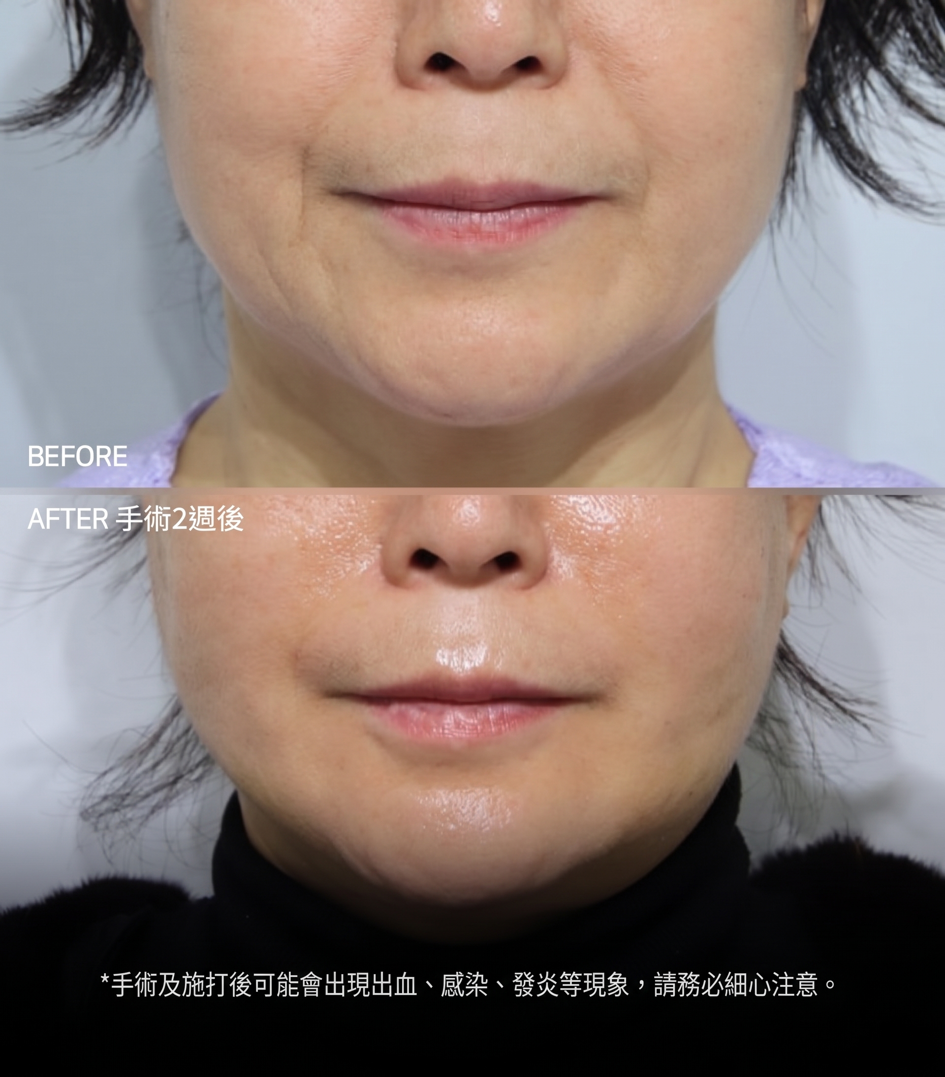 釜山迷你拉皮：為什麼不能只單純拉緊皮膚？ 사진 5