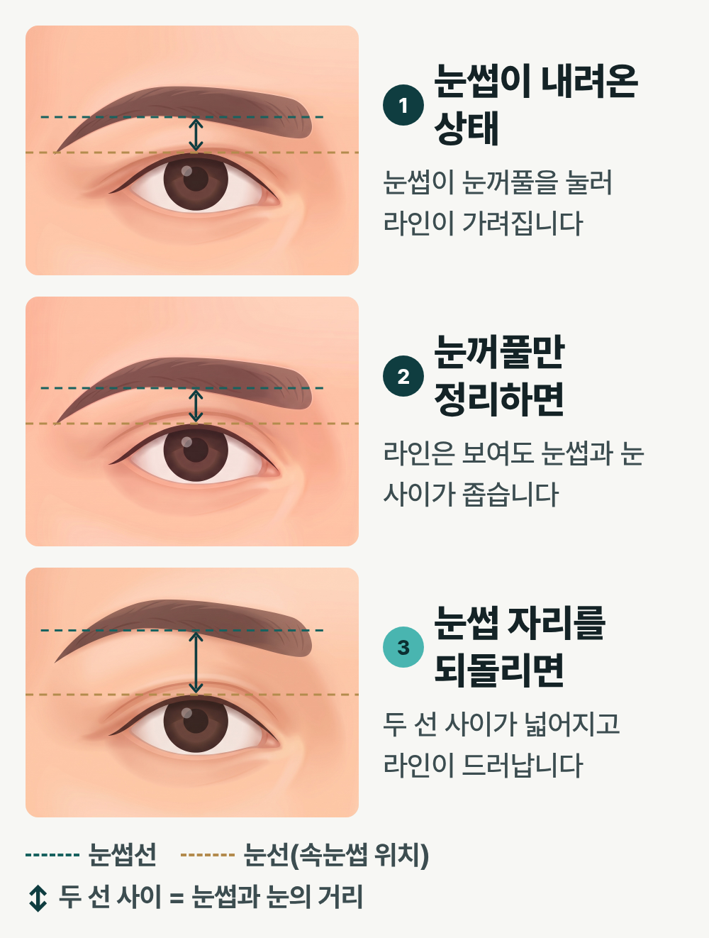 부산이마거상 쌍꺼풀 수술했는데도 눈이 답답하다면? 이마 처짐을 확인해야 하는 이유 사진 3