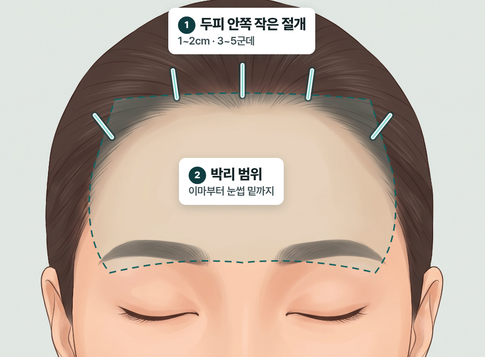 부산이마거상 쌍꺼풀 수술했는데도 눈이 답답하다면? 이마 처짐을 확인해야 하는 이유