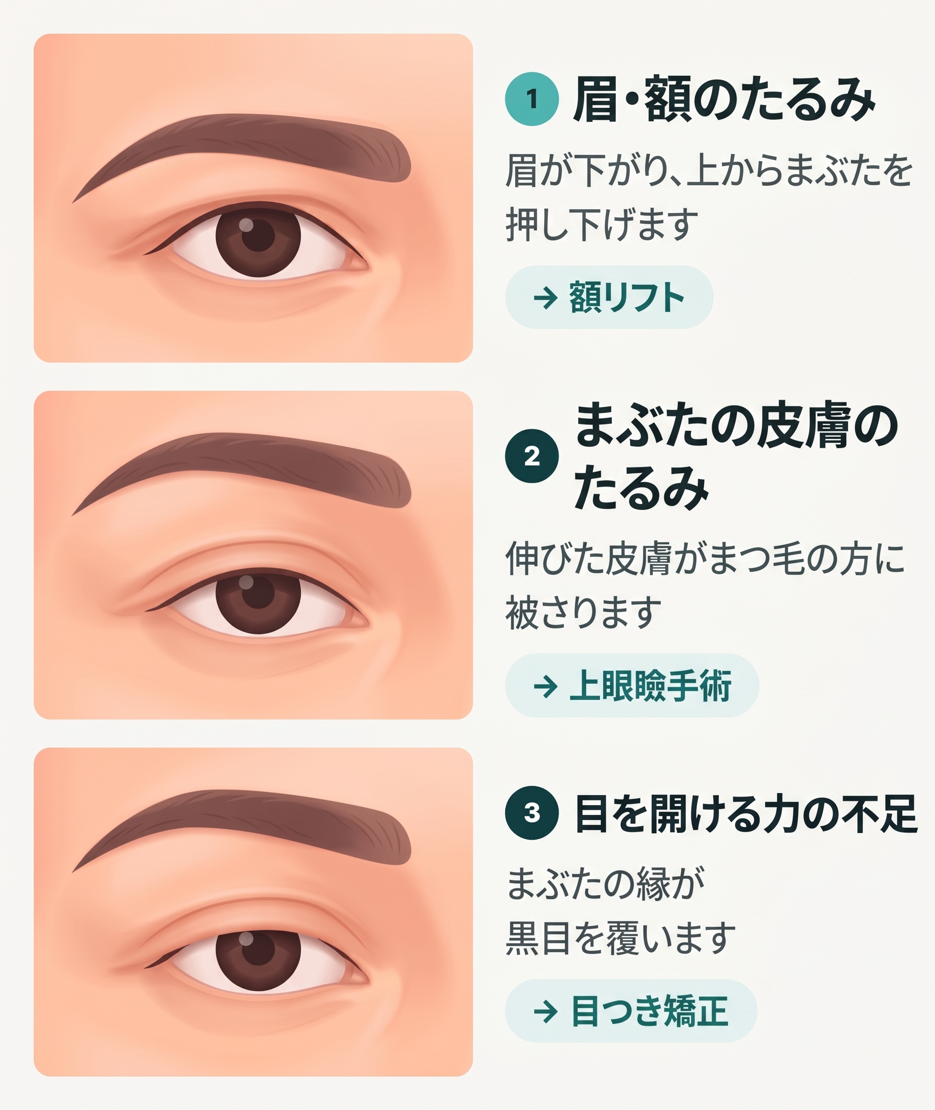 釜山額リフト｜二重手術をしたのに目が重苦しいなら？額の垂れ下がりを確認すべき理由 사진 2