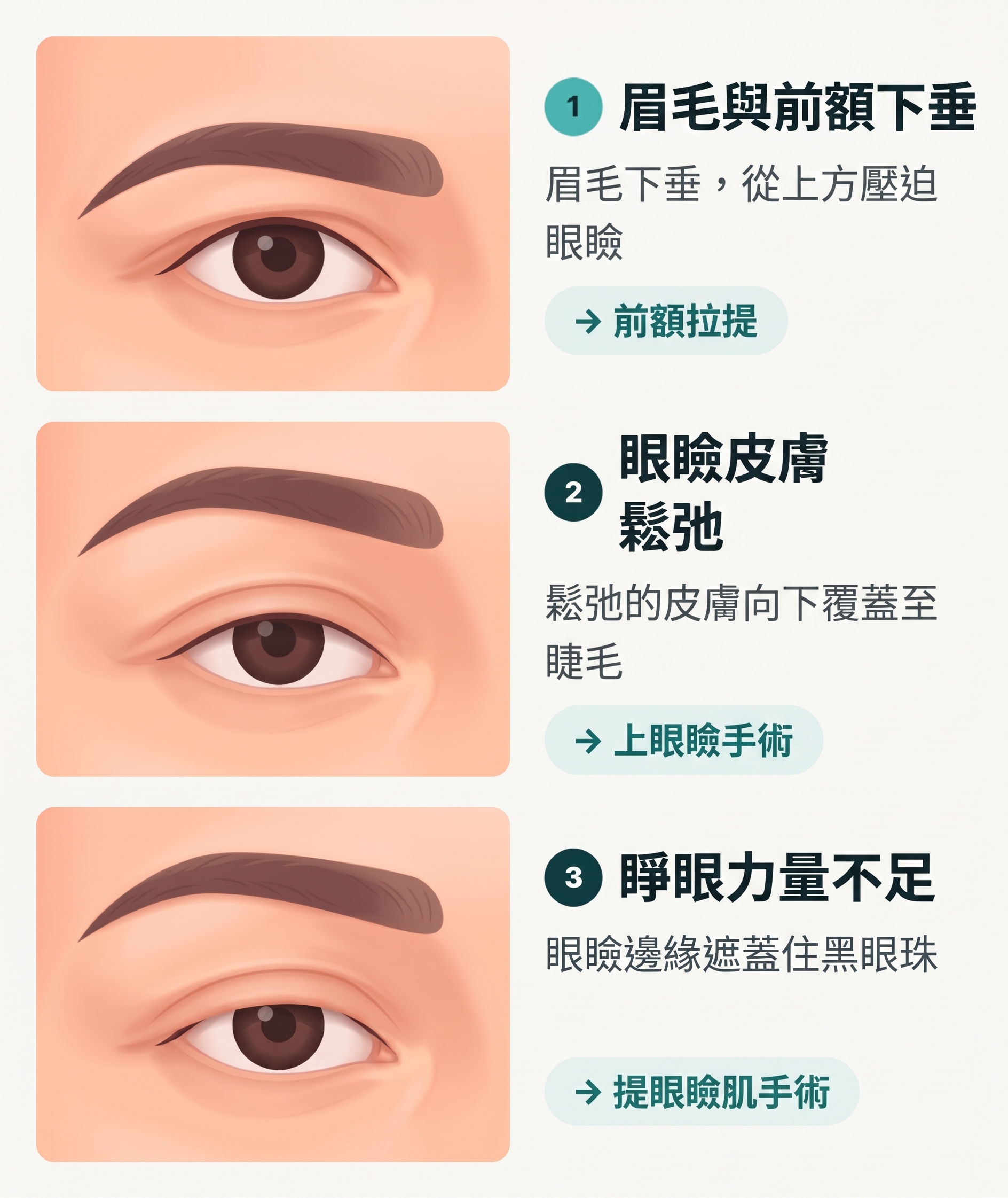 釜山額頭提拉：做了雙眼皮手術，眼睛還是覺得悶？為什麼要確認額頭下垂 사진 2
