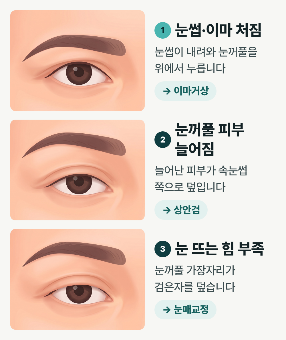 부산이마거상 쌍꺼풀 수술했는데도 눈이 답답하다면? 이마 처짐을 확인해야 하는 이유 사진 2