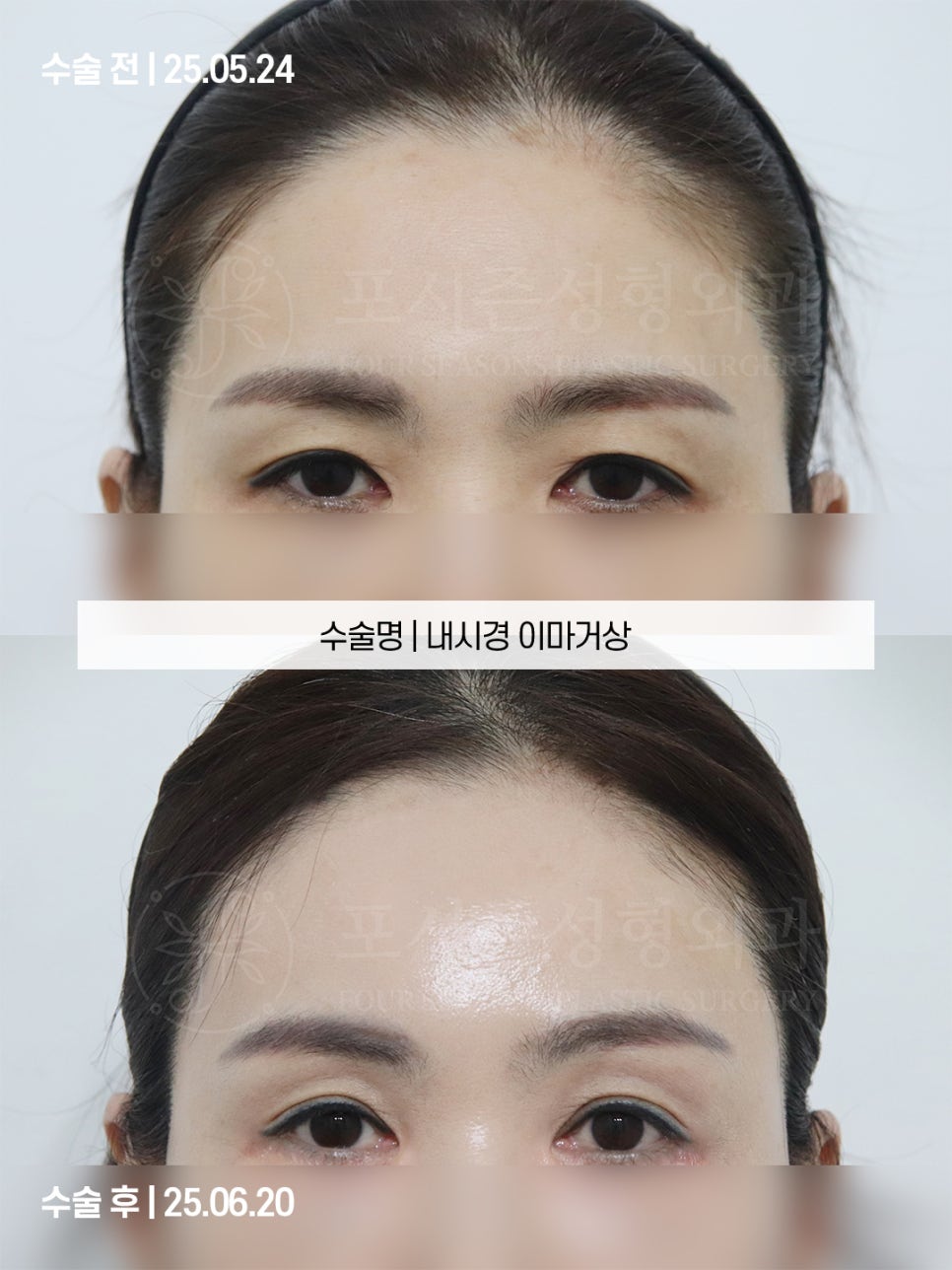 부산이마거상 쌍꺼풀 수술했는데도 눈이 답답하다면? 이마 처짐을 확인해야 하는 이유 사진 6