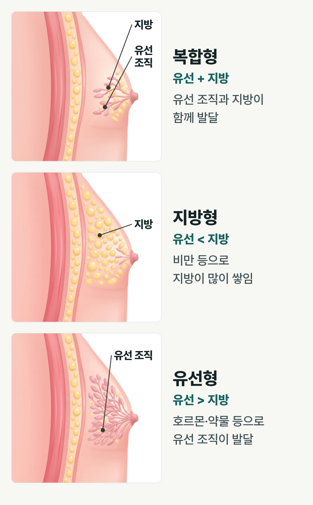 부산여유증수술 다이어트해도 가슴만 그대로라면? 지방인지 유선조직인지 확인하세요 사진 3