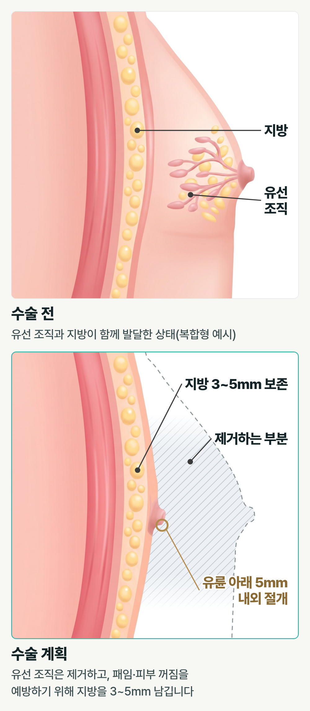 부산여유증수술 다이어트해도 가슴만 그대로라면? 지방인지 유선조직인지 확인하세요 사진 5