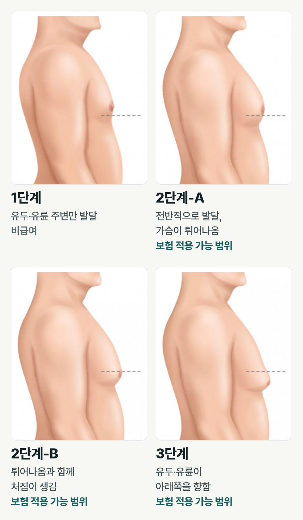 부산여유증수술 다이어트해도 가슴만 그대로라면? 지방인지 유선조직인지 확인하세요 사진 7