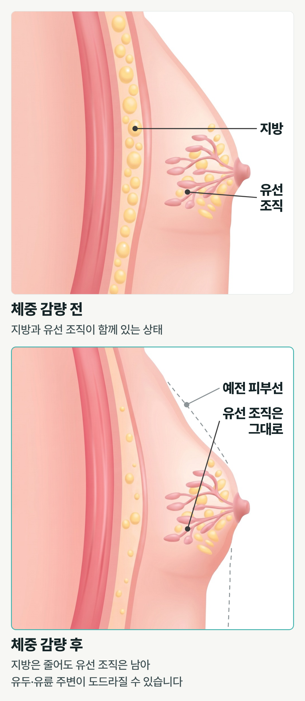 부산여유증수술 다이어트해도 가슴만 그대로라면? 지방인지 유선조직인지 확인하세요 사진 4
