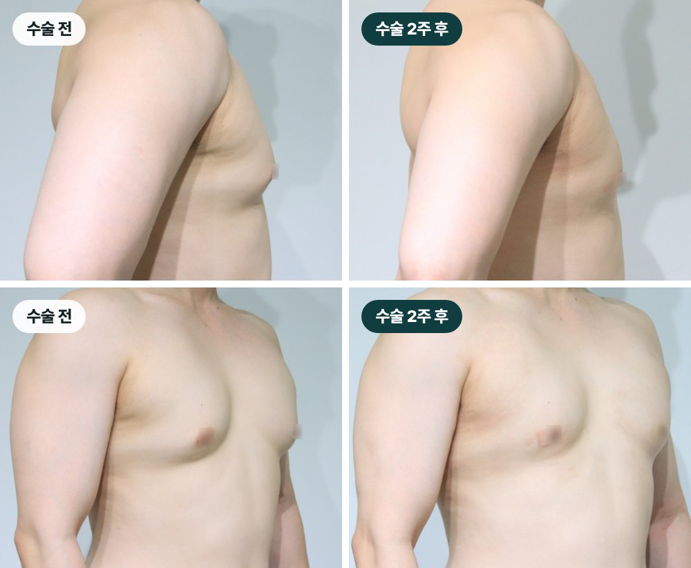 부산여유증수술 다이어트해도 가슴만 그대로라면? 지방인지 유선조직인지 확인하세요 사진 6